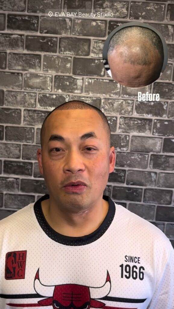Scalp Micro Pigmentation in Beverly Hills – Natural Hair Loss Solutions at EVA BAY Aesthetics