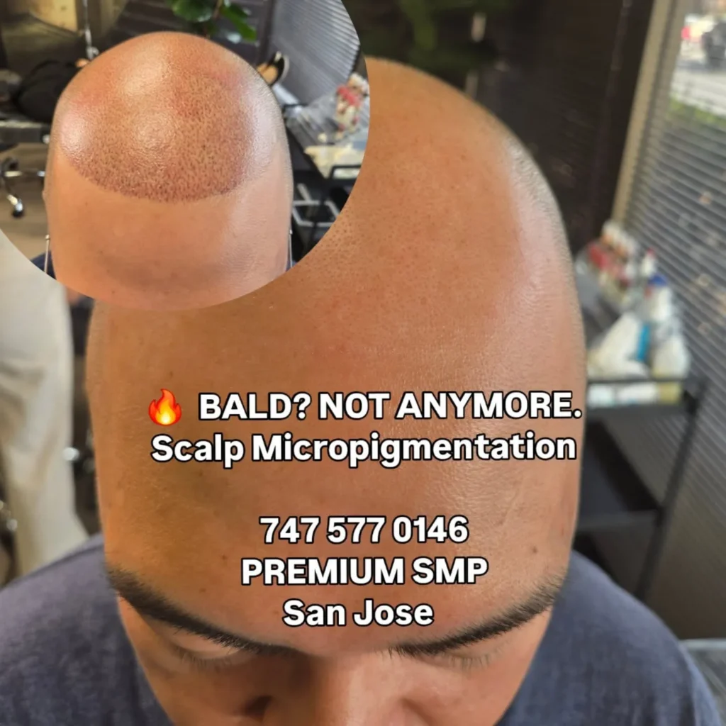 Scalp Micropigmentation San Jose Before and After | Natural SMP Hairline Restoration