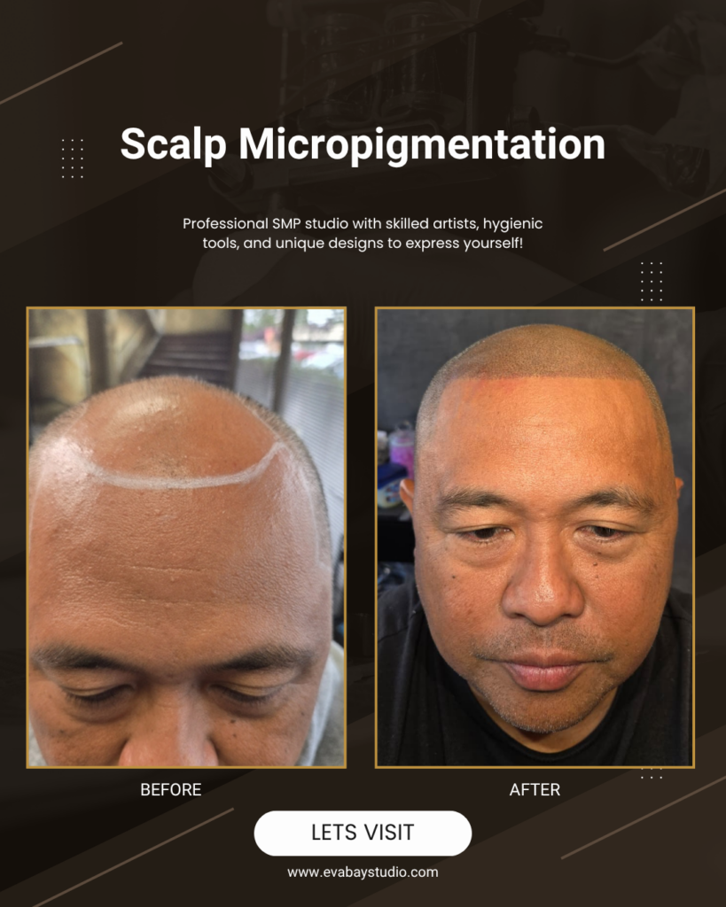 Hairline Design for Scalp Micropigmentation