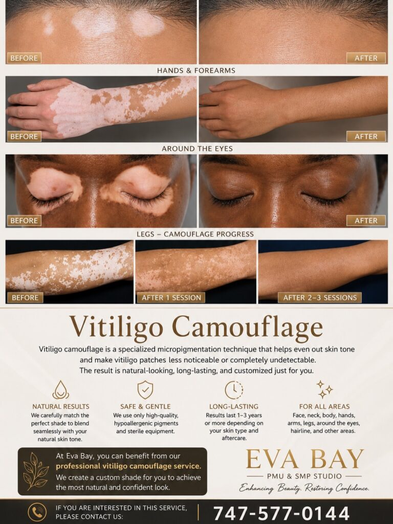 Vitiligo Camouflage in Beverly Hills & San Jose Eva Bay